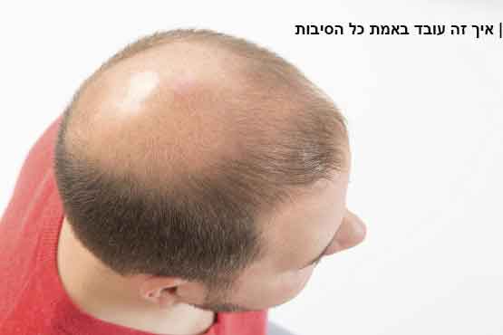 השתלת שיער אחוזי הצלחה
